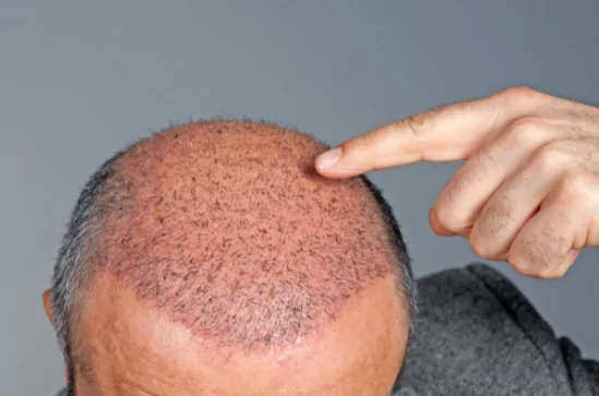 3 Best Hair Transplant Surgeons in Nagpur MH  ThreeBestRated