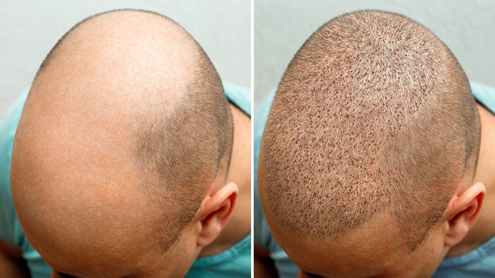 less hair and growing hair difference during treatment