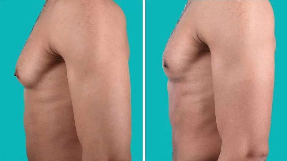 increases boobs in men's