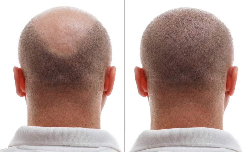 left side less hair and right side hair growth result