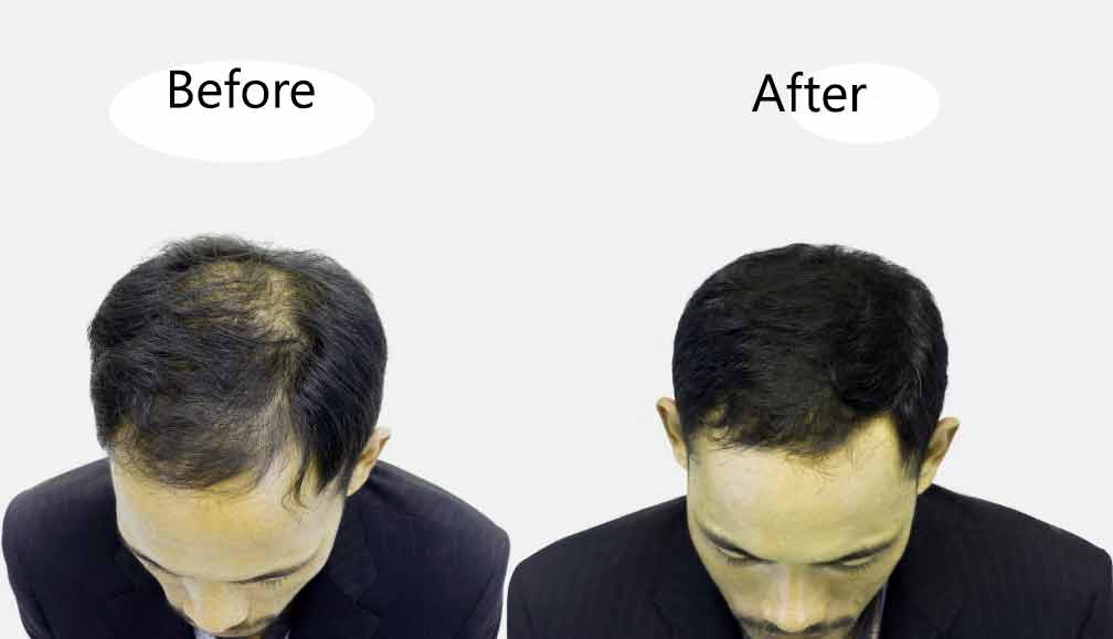 after before treatment effect boy